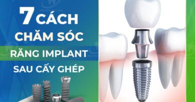 7 cach cham soc sau cay ghep implant 768x576 1