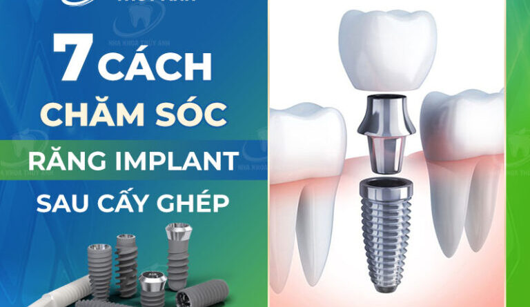 7 cach cham soc sau cay ghep implant 768x576 1